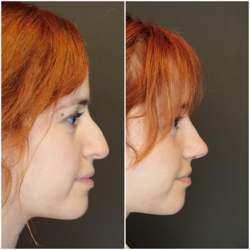Rinoplastia ultrasónica Fotos del antes y el después